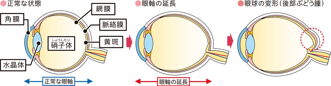 正常な状態、目軸の延長、眼球の変形（後部部どう腫）